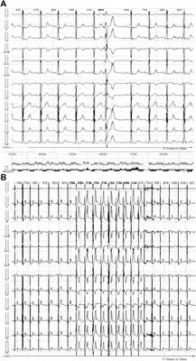 Case Report: Loss-of-Function ABCC9 Genetic Variant Associated With Ventricular Fibrillation